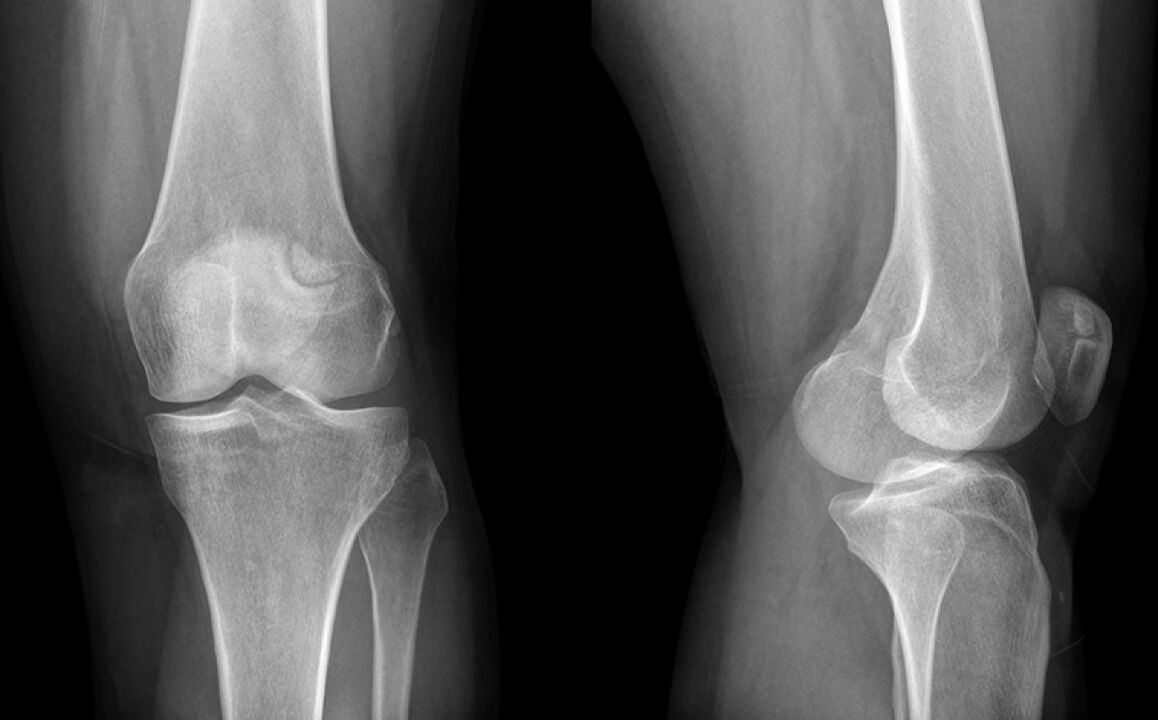 D'Arthrosis vum Knéi op der X -ray virum Gebrauch vun der Hondroin
