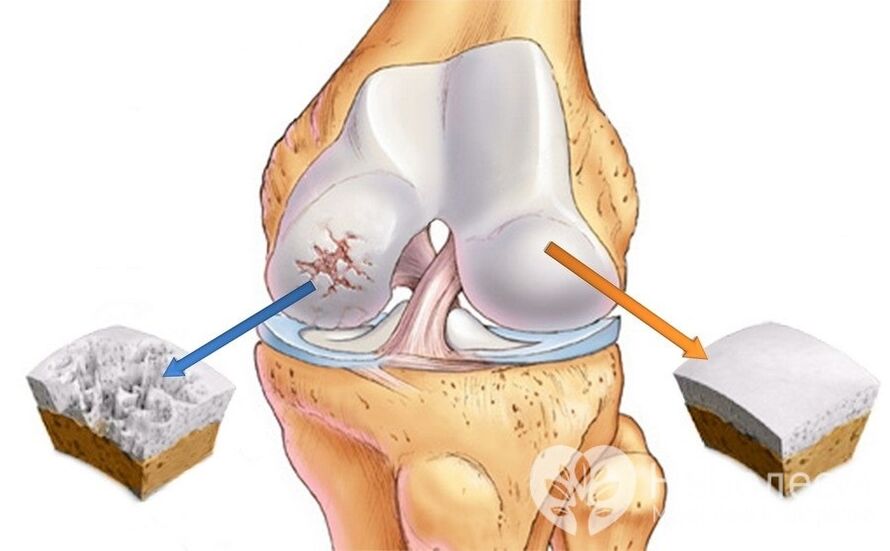 Arthrosis vum Knéi