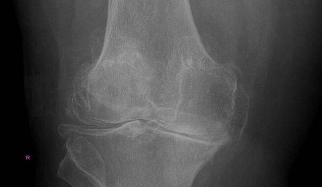 Diagnos vun Arthrosis