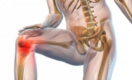 Arthrosis vum Knéi Gelenk