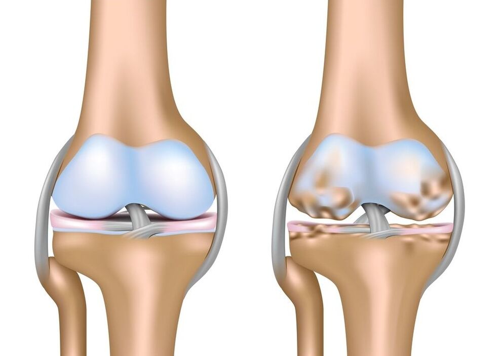 Arthrosis vum Knéi Gelenk