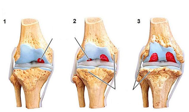 De Grad vun der Entwécklung vu Arthrosis