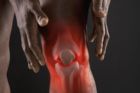 Symptomer vun Arthrosis