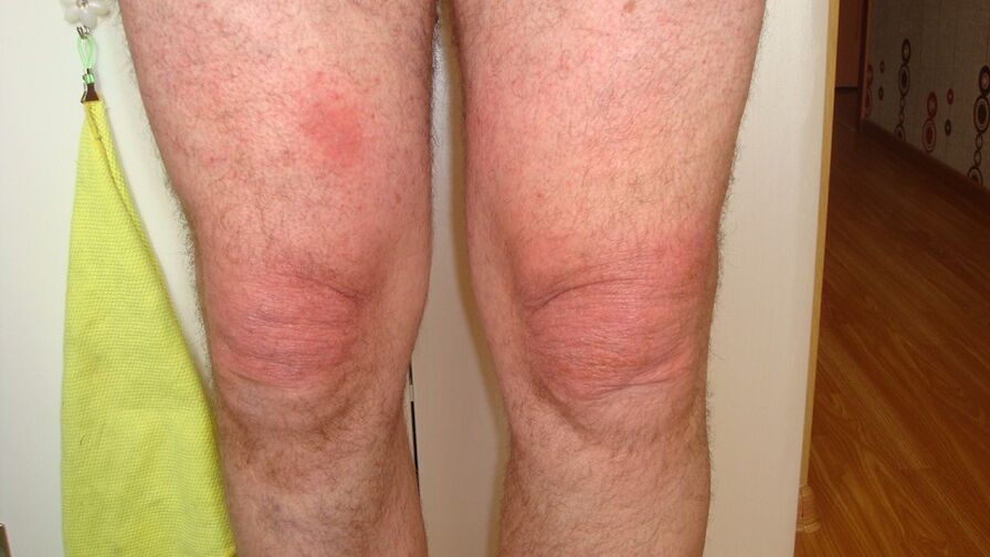 Arthrosis vun de Knéi Gelenker