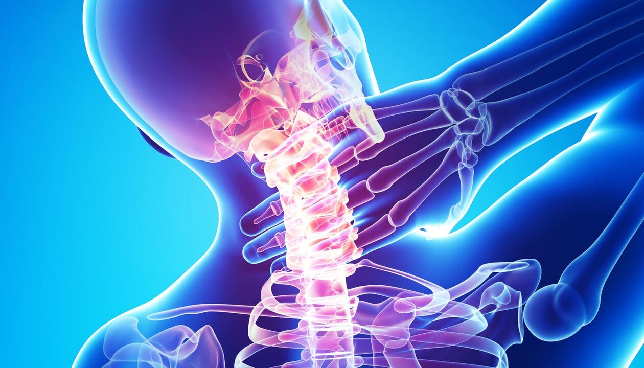 Hals Schmerz wéinst Osteochondrose